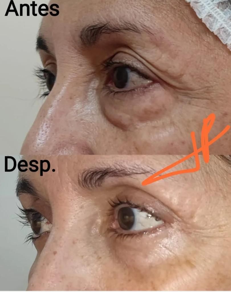 Antes y después de una blefaroplastia: se ve la zona de los párpados de una paciente.