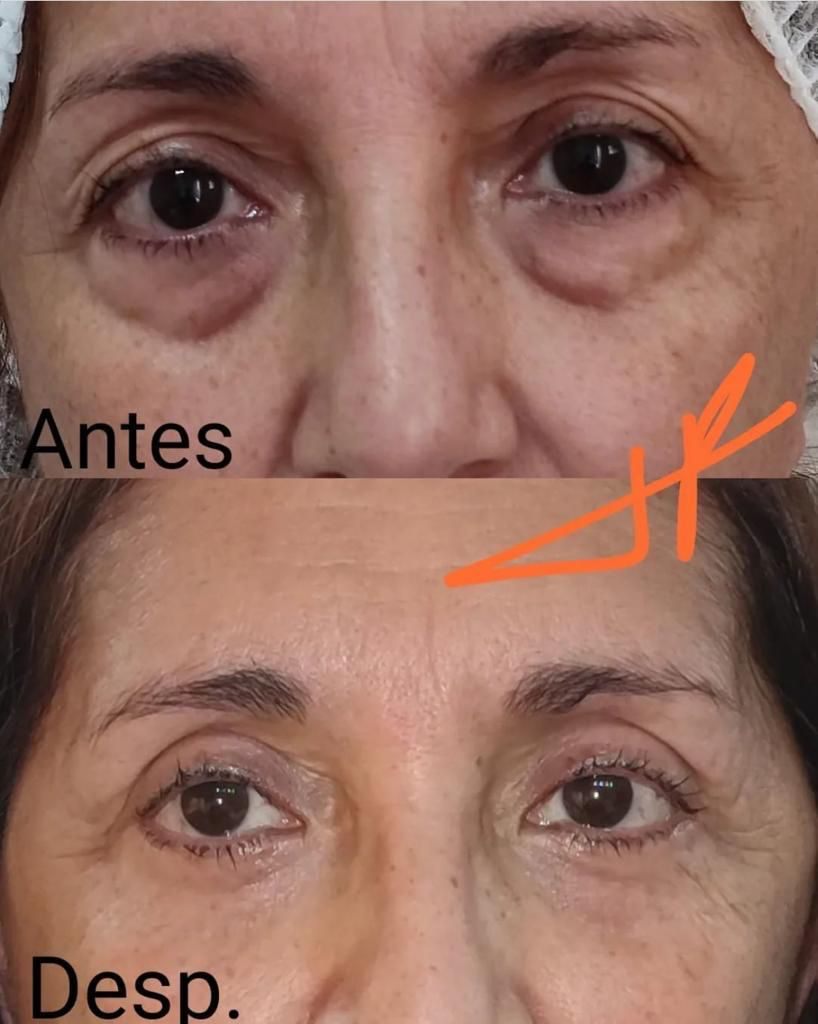 Antes y después de una blefaroplastia, caso 2.