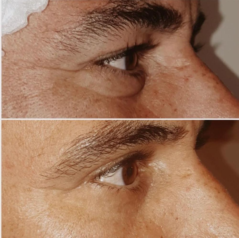 Antes y después de una blefaroplastia, caso 3.