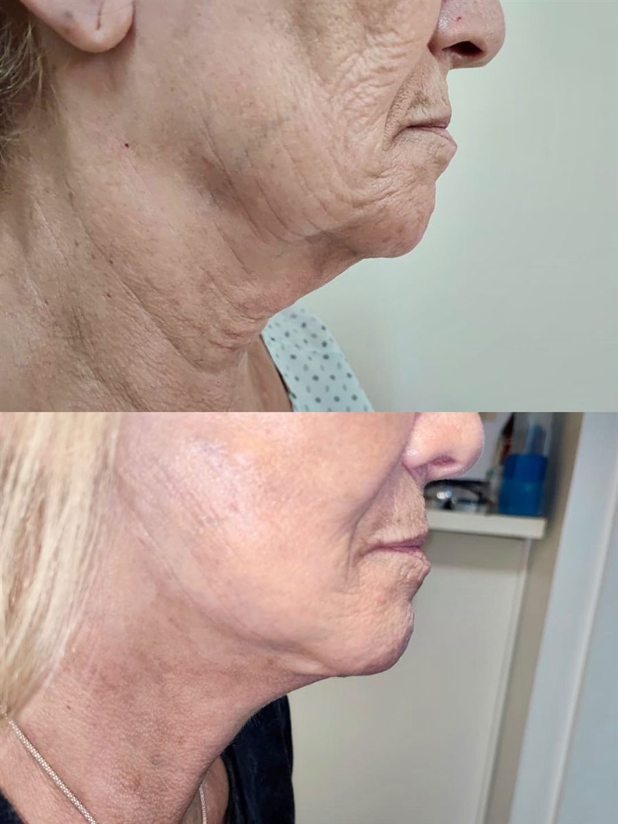 Antes y después de un lifting: perfil del rostro y el cuello de una paciente.
