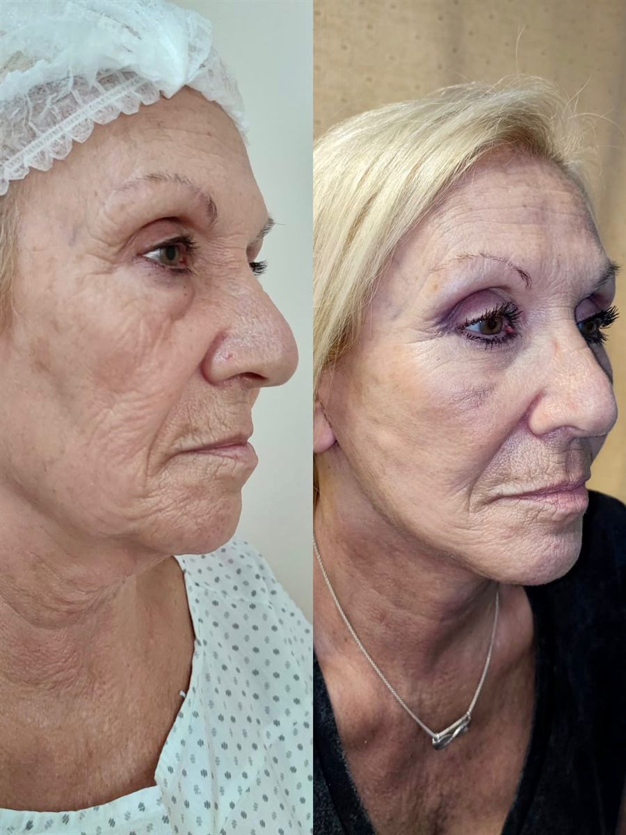 Antes y después de un lifting facial, caso 2.