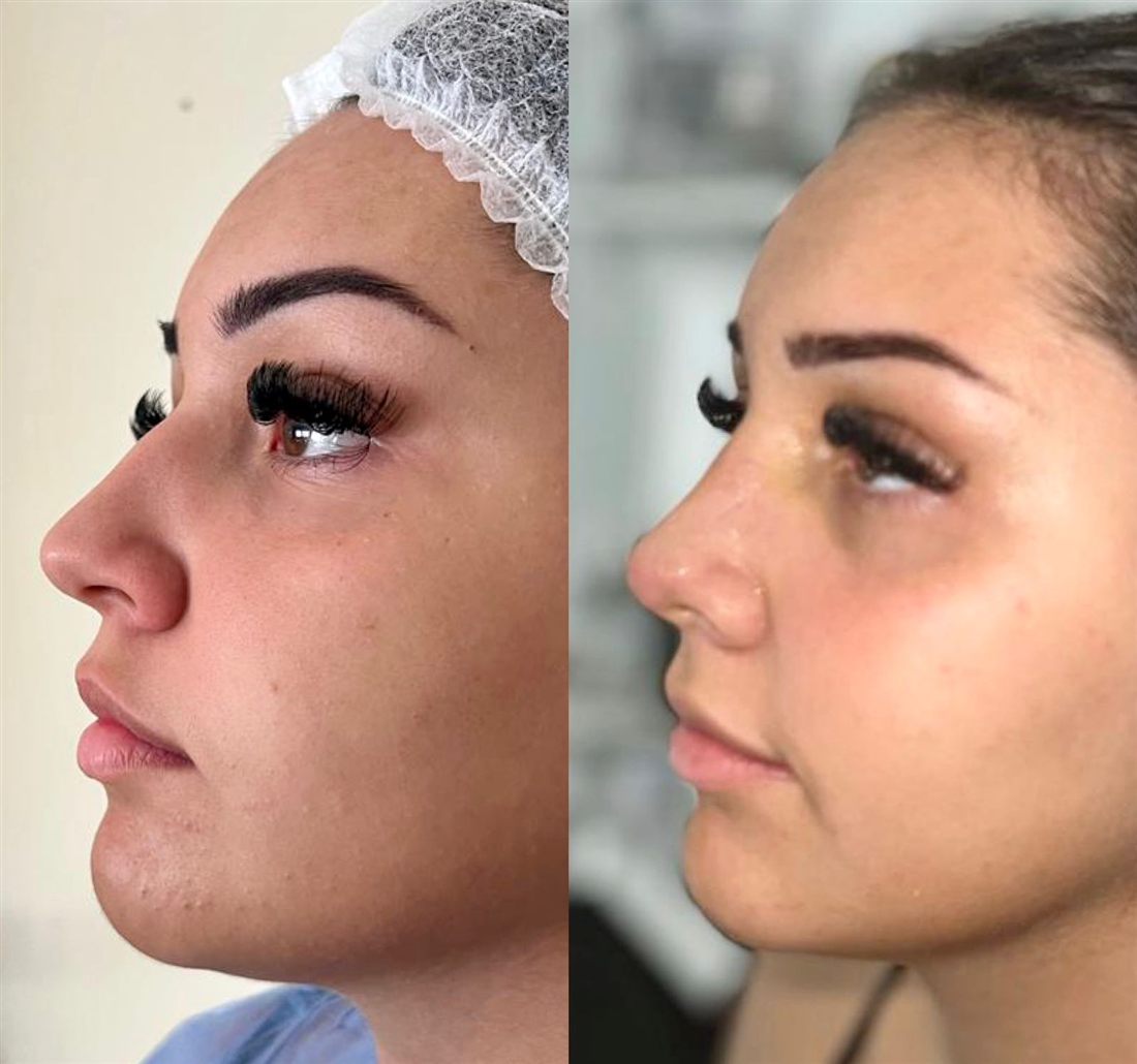 Antes y después de una rinoplastia, caso 1.