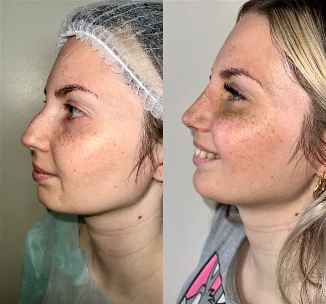 Antes y después de una rinoplastia, caso 2.