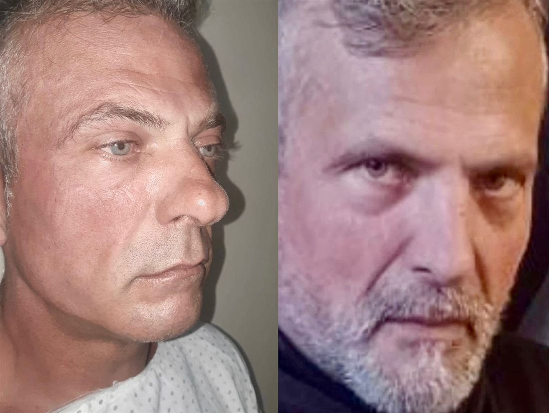 Antes y después de una rinoplastia, caso 3.