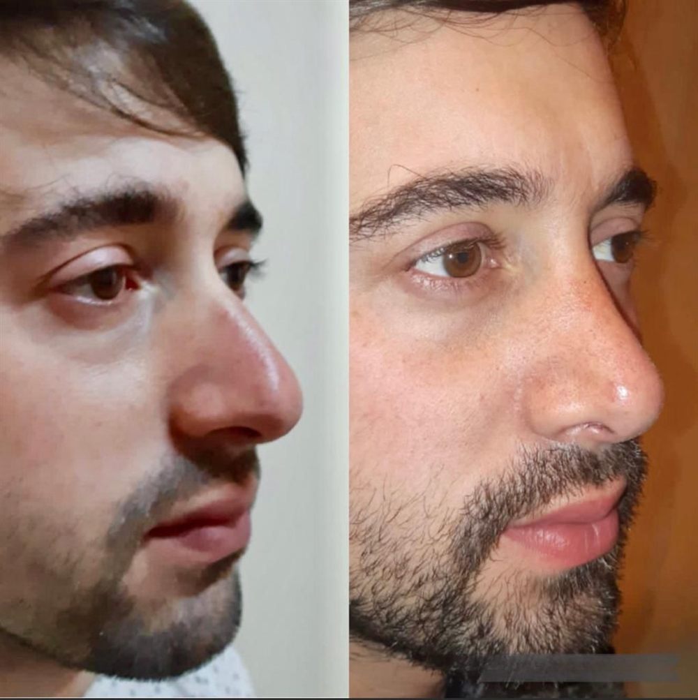 Antes y después de una rinoplastia: perfil de un paciente.