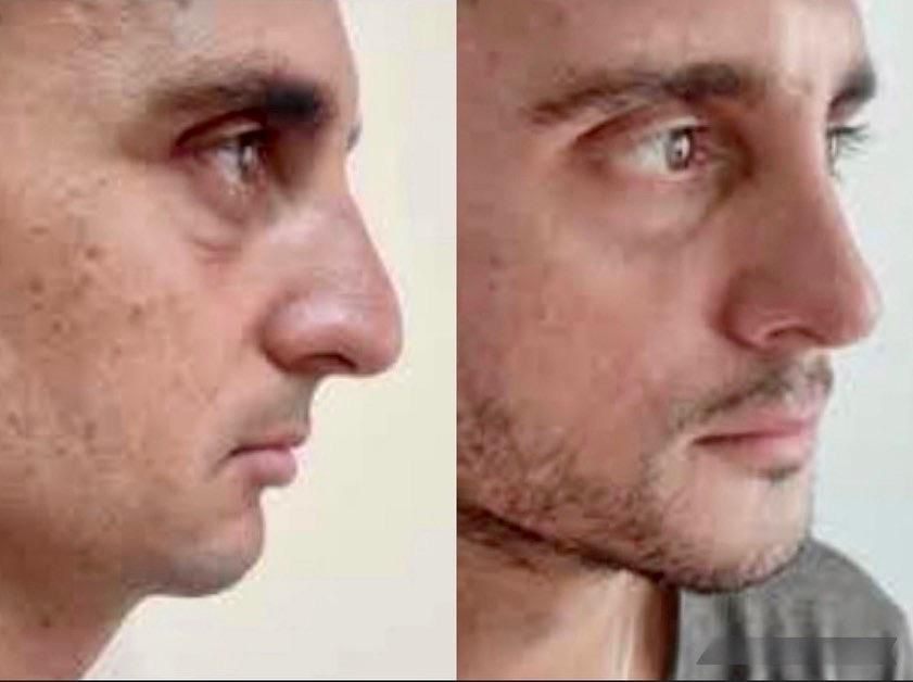 Antes y después de una rinoplastia, caso 5.